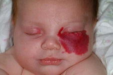 Hemanjiom Belirtileri ve Tedavisi