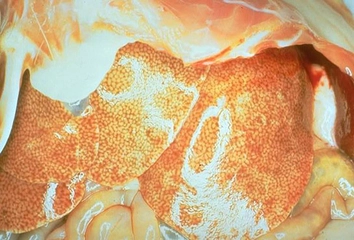 Karaciğer Yağlanması Belirtileri ve Tedavisi