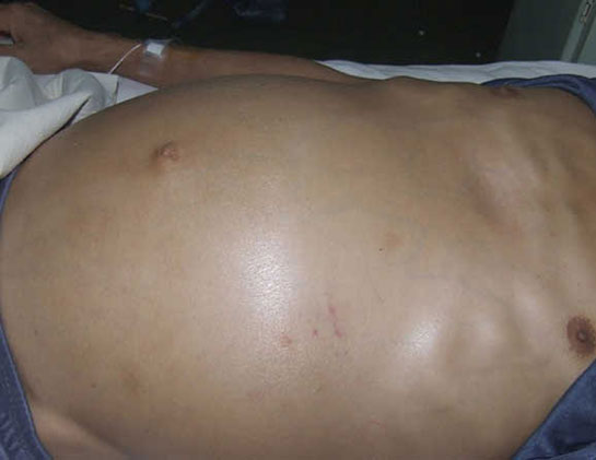 Karaciğer Su Toplaması Belirtileri ve Tedavisi